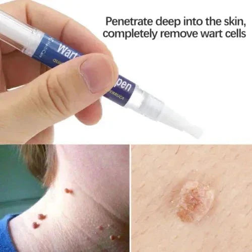 Warts & Moles Remover Pen (14 Days Money Back Guarantee) - My Store