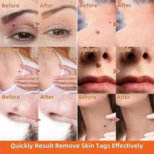 Warts & Moles Remover Pen (14 Days Money Back Guarantee) - My Store