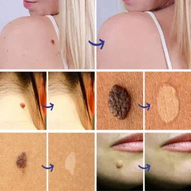 Warts & Moles Remover Pen (14 Days Money Back Guarantee) - My Store