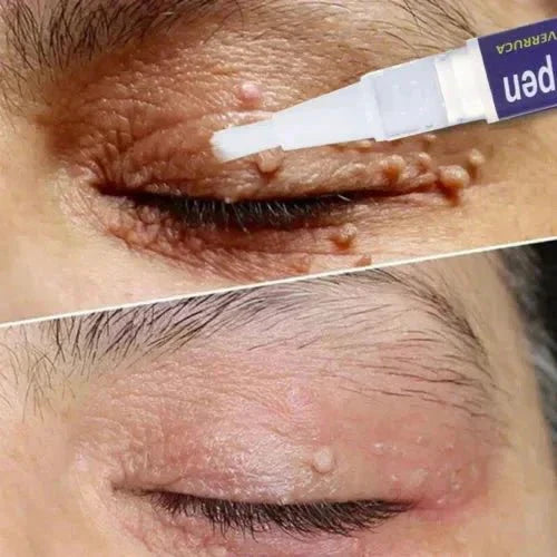 Warts & Moles Remover Pen (14 Days Money Back Guarantee) - My Store